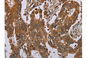 The image on the left is immunohistochemistry of paraffin-embedded Human colon cancer tissue using ABIN7191746(OSM Antibody) at dilution 1/40, on the right is treated with synthetic peptide. (Oncostatin M Antikörper)