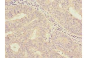 Immunohistochemistry of paraffin-embedded human endometrial cancer using ABIN7157058 at dilution of 1:100 (ISCU Antikörper  (AA 1-167))