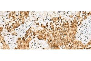 Immunohistochemistry of paraffin-embedded Human ovarian cancer tissue using CRCP Polyclonal Antibody at dilution of 1:65(x200) (CRCP Antikörper)