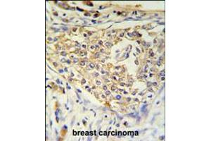 ADFP Antibody IHC analysis in formalin fixed and paraffin embedded breast carcinoma followed by peroxidase conjugation of the secondary antibody and DAB staining. (ADRP Antikörper  (AA 186-214))
