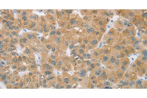 Immunohistochemistry of paraffin-embedded Human liver cancer tissue using CYP2C9 Polyclonal Antibody at dilution 1:35 (CYP2C9 Antikörper)