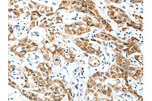 The image on the left is immunohistochemistry of paraffin-embedded Human lung cancer tissue using ABIN7130157(MAP3K14 Antibody) at dilution 1/30, on the right is treated with fusion protein.