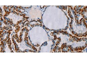 Immunohistochemistry of paraffin-embedded Human thyroid cancer tissue using CMC4 Polyclonal Antibody at dilution 1:55 (CMC4 Antikörper)