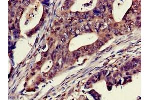 Immunohistochemistry of paraffin-embedded human colon cancer using ABIN7150733 at dilution of 1:100 (Mps1 Antikörper  (AA 370-492))