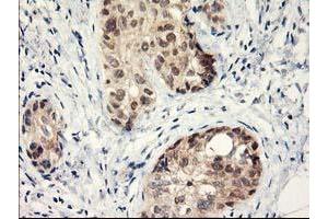 Immunohistochemical staining of paraffin-embedded Adenocarcinoma of Human breast tissue using anti-LPL mouse monoclonal antibody. (Lipoprotein Lipase Antikörper  (AA 28-475))