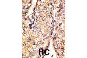 Formalin-fixed and paraffin-embedded human cancer tissue reacted with the primary antibody, which was peroxidase-conjugated to the secondary antibody, followed by DAB staining. (GDF10 Antikörper  (N-Term))