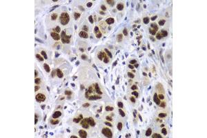 Immunohistochemistry of paraffin-embedded human gastric cancer using SF3B2 antibody (ABIN5973482) at dilution of 1/100 (40x lens). (SF3B2 Antikörper)