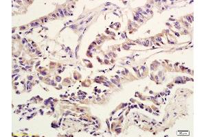 Formalin-fixed and paraffin embedded human colon cancer labeled with Anti Amphiregulin Polyclonal Antibody, Unconjugated  at 1:600 followed by conjugation to the secondary antibody and DAB staining (Amphiregulin Antikörper  (AA 185-252))