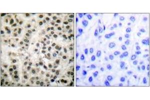 Immunohistochemistry analysis of paraffin-embedded human breast carcinoma tissue, using MEF2A (Ab-408) Antibody. (MEF2A Antikörper  (AA 374-423))