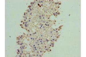 Immunohistochemistry of paraffin-embedded human breast cancer using ABIN7144801 at dilution of 1:100 (ATXN7L1 Antikörper  (AA 1-146))