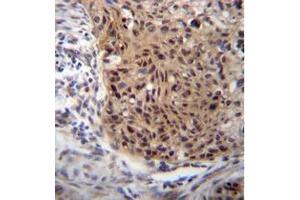 Formalin fixed and paraffin embedded human esophageal carcinoma reacted with EXTL3 Antibody (N-term) followed by peroxidase conjugation of the secondary antibody and DAB staining. (EXTL3 Antikörper  (N-Term))