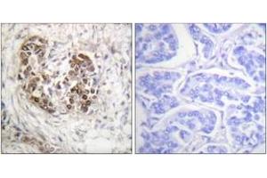Immunohistochemistry analysis of paraffin-embedded human breast carcinoma tissue, using p53 (Ab-20) Antibody. (p53 Antikörper  (AA 10-59))