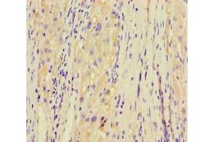 Immunohistochemistry of paraffin-embedded human liver cancer using ABIN7145840 at dilution of 1:100
