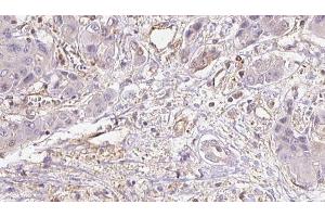 ABIN6273935 at 1/100 staining Human liver cancer tissue by IHC-P. (GPR39 Antikörper  (C-Term))