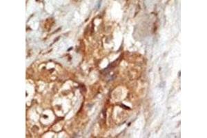 IHC analysis of FFPE human breast carcinoma tissue stained with the NIK antibody