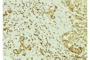ABIN6269141 at 1/100 staining Human breast cancer tissue by IHC-P. (Src Antikörper  (N-Term))