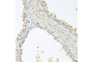Immunohistochemistry of paraffin-embedded human prostate using PMM2 antibody at dilution of 1:100 (x40 lens).