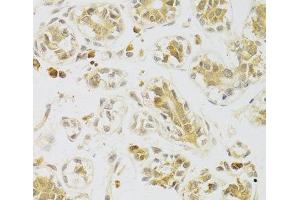 Immunohistochemistry of paraffin-embedded Human breast using Caspase-2 Polyclonal Antibody at dilution of 1:100 (40x lens). (Caspase 2 Antikörper)