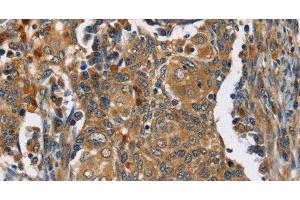 Immunohistochemistry of paraffin-embedded Human cervical cancer tissue using TAC1 Polyclonal Antibody at dilution 1:25 (TAC1 Antikörper)