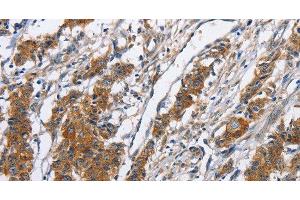 Immunohistochemistry of paraffin-embedded Human gasrtic cancer tissue using NCAPD3 Polyclonal Antibody at dilution 1:50 (NCAPD3 Antikörper)