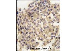 Forlin-fixed and paraffin-embedded hun breast carcino tissue reacted with P2K1 Antibody  (ABIN1881525 and ABIN2842060) , which was peroxidase-conjugated to the secondary antibody, followed by DAB staining. (MEK1 Antikörper  (AA 270-299))