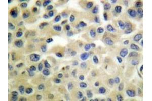 Immunohistochemistry analyzes of IKKα/β antibody in paraffin-embedded human breast carcinoma tissue. (IKK alpha Antikörper)