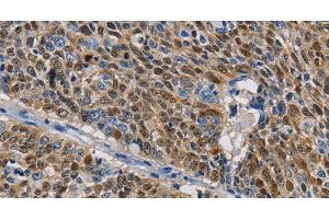 Immunohistochemistry of paraffin-embedded Human lung cancer tissue using GSTA2 Polyclonal Antibody at dilution 1:50 (GSTa2 Antikörper)
