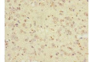Immunohistochemistry of paraffin-embedded human glioma using ABIN7167625 at dilution of 1:100 (RGS Antikörper  (AA 230-350))