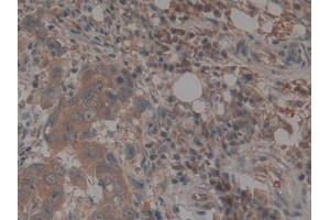 IHC-P analysis of Human Breast cancer Tissue, with DAB staining. (TEP1 Antikörper  (AA 2368-2627))