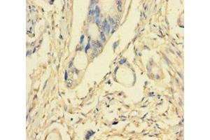 Immunohistochemistry of paraffin-embedded human pancreatic cancer using ABIN7163295 at dilution of 1:100 (PIK3R5 Antikörper  (Regulatory Subunit 5))