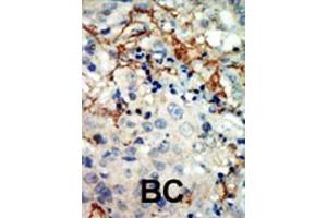 Formalin-fixed and paraffin-embedded human cancer tissue reacted with the primary antibody, which was peroxidase-conjugated to the secondary antibody, followed by AEC staining. (EPH Receptor A3 Antikörper  (N-Term))
