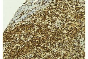 ABIN6273779 at 1/100 staining Human breast cancer tissue by IHC-P. (BCL2L13 Antikörper  (Internal Region))