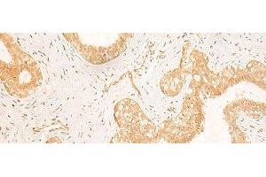 Immunohistochemistry of paraffin-embedded Human breast cancer tissue using GSG1L Polyclonal Antibody at dilution of 1:50(x200) (GSG1-Like Antikörper)