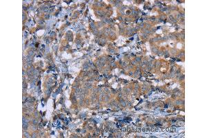 Immunohistochemistry of Human breast cancer using PON1 Polyclonal Antibody at dilution of 1:40 (PON1 Antikörper)