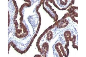 Formalin-fixed, paraffin-embedded human ovarian carcinoma stained with Cytokeratin 7 antibody (KRT7/760) (Cytokeratin 7 Antikörper)