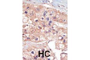 Formalin-fixed and paraffin-embedded human hepatocellular carcinoma tissue reacted with UHMK1 polyclonal antibody  , which was peroxidase-conjugated to the secondary antibody, followed by DAB staining. (UHMK1 Antikörper  (N-Term))