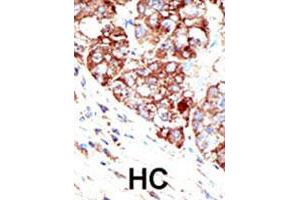 Formalin-fixed and paraffin-embedded human hepatocellular carcinoma tissue reacted with PIAS1 polyclonal antibody , which was peroxidase-conjugated to the secondary antibody, followed by DAB staining. (PIAS1 Antikörper  (C-Term))