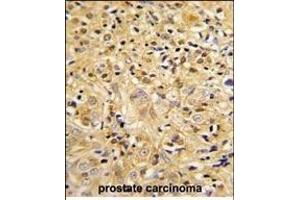 Formalin-fixed and paraffin-embedded human prostate carcinoma reacted with LUM Antibody (Center), which was peroxidase-conjugated to the secondary antibody, followed by DAB staining.