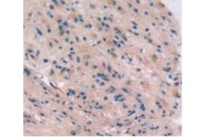 IHC-P analysis of Human Glioma Tissue, with DAB staining. (Integrin beta 5 Antikörper  (AA 137-378))