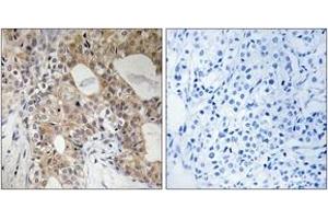 Immunohistochemistry analysis of paraffin-embedded human breast carcinoma, using SPHK2 (Phospho-Thr614) Antibody. (SPHK2 Antikörper  (pThr614))