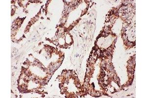 IHC-P: CNTF antibody testing of human lung cancer tissue (CNTF Antikörper  (AA 2-200))