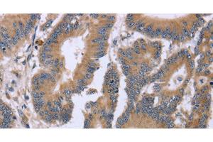 Immunohistochemistry of paraffin-embedded Human colon cancer tissue using KIAA1324 Polyclonal Antibody at dilution 1:30 (ELAPOR1 Antikörper)