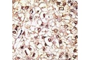 IHC analysis of FFPE human hepatocarcinoma tissue stained with the Parkin antibody
