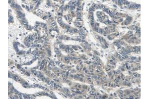 IHC-P analysis of Human Lung Cancer Tissue, with DAB staining. (ERBB4 Antikörper  (AA 29-278))