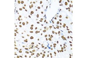 Immunohistochemistry of paraffin-embedded human prostate cancer using KHDRBS1 antibody. (KHDRBS1 Antikörper  (C-Term))