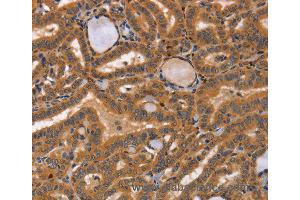 Immunohistochemistry of Human lymphoma using CCL23 Polyclonal Antibody at dilution of 1:50