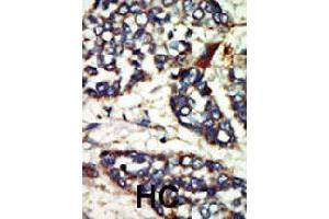 Formalin-fixed and paraffin-embedded human hepatocellular carcinoma tissue reacted with NEK1 polyclonal antibody  , which was peroxidase-conjugated to the secondary antibody, followed by DAB staining. (NEK1 Antikörper  (C-Term))