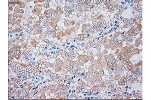 Immunohistochemical staining of paraffin-embedded liver tissue using anti-KRT19mouse monoclonal antibody. (Cytokeratin 19 Antikörper  (AA 240-390))