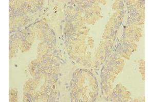 Immunohistochemistry of paraffin-embedded human prostate cancer using ABIN7171826 at dilution of 1:100 (Twisted Gastrulation BMP Signaling Modulator 1a (TWSG1A) (AA 1-200) Antikörper)