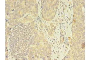 Immunohistochemistry of paraffin-embedded human gastric cancer using ABIN7162815 at dilution of 1:100 (FKBP11 Antikörper  (AA 28-154))